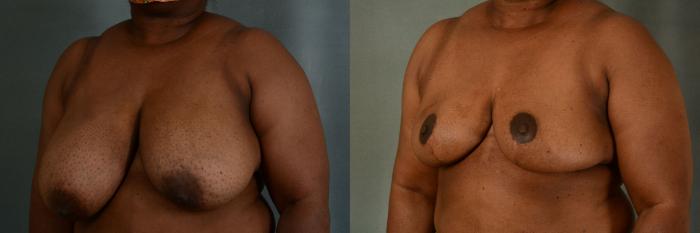 Before & After Breast Reduction Case 425 View #2 View in Tallahassee, FL