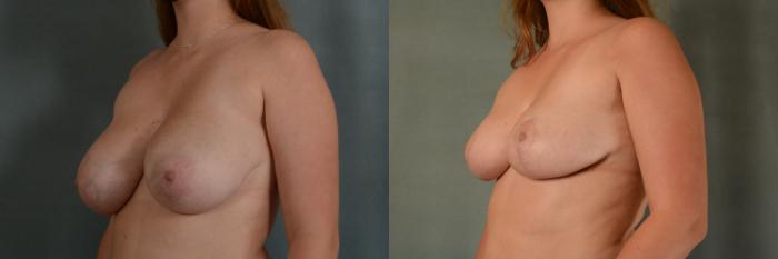 Before & After Breast Reduction Case 439 Left Oblique View in Tallahassee, FL