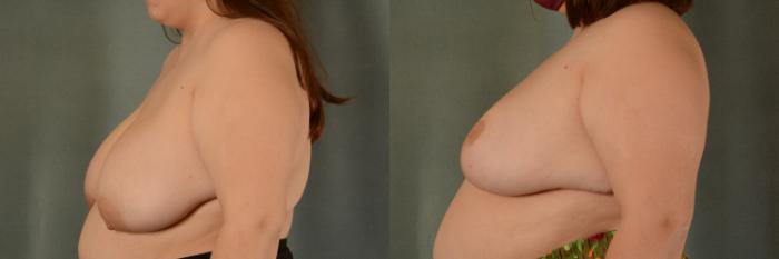 Before & After Breast Reduction Case 445 Left Side View in Tallahassee, FL