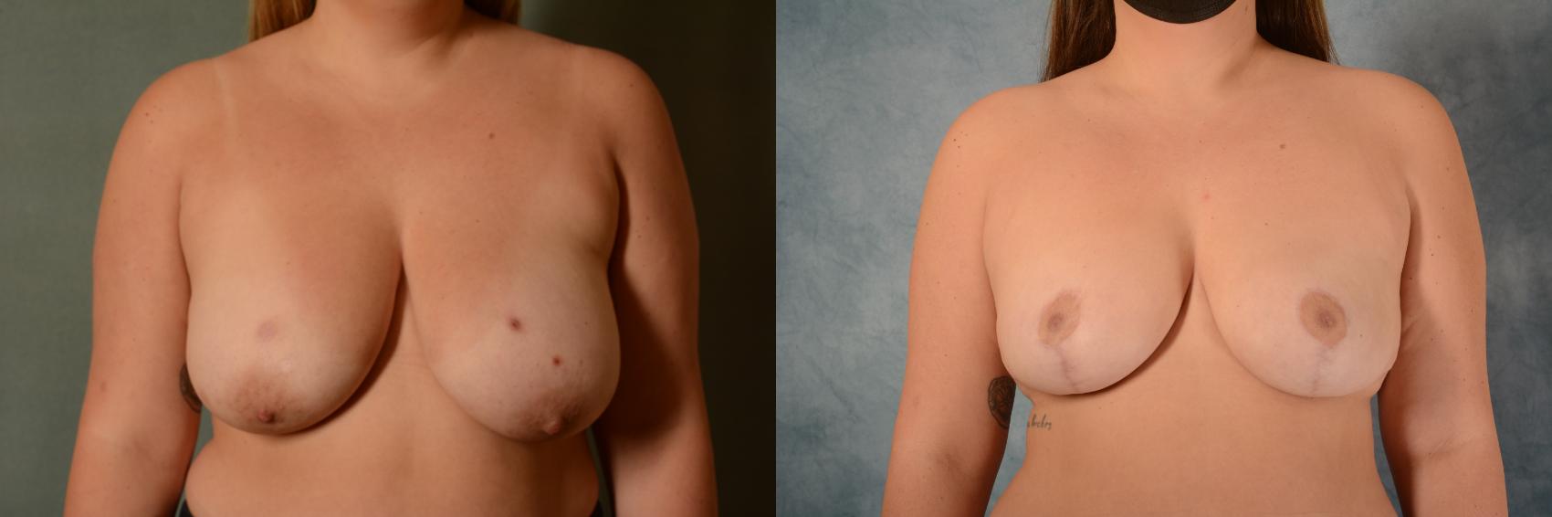Before & After Breast Reduction Case 454 Front View in Tallahassee, FL