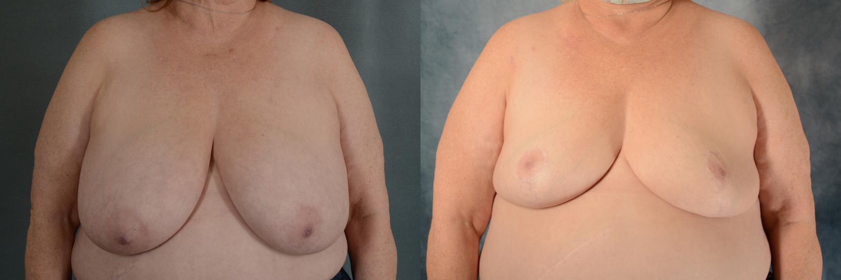 Before & After Breast Reduction Case 455 Front View in Tallahassee, FL