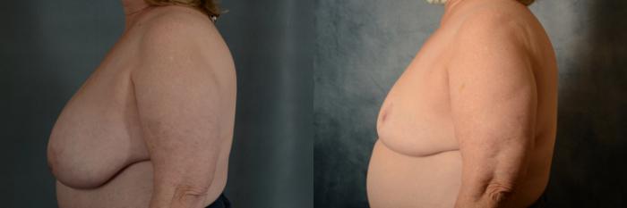 Before & After Breast Reduction Case 455 Left Side View in Tallahassee, FL