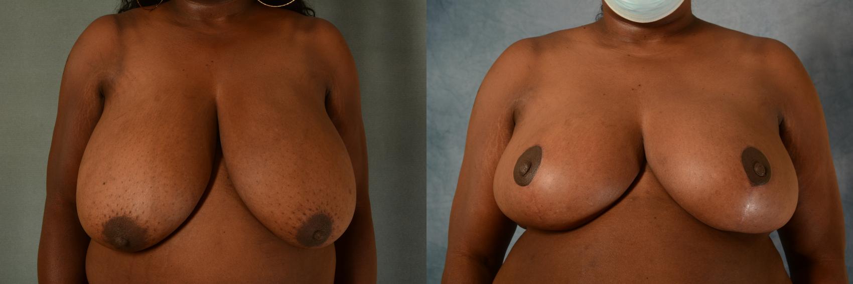 Before & After Breast Reduction Case 470 Front View in Tallahassee, FL
