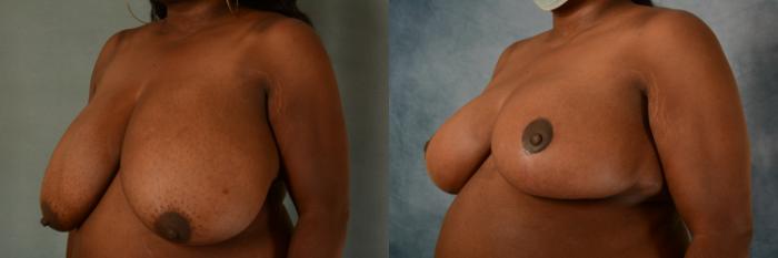 Before & After Breast Reduction Case 470 Left Oblique View in Tallahassee, FL