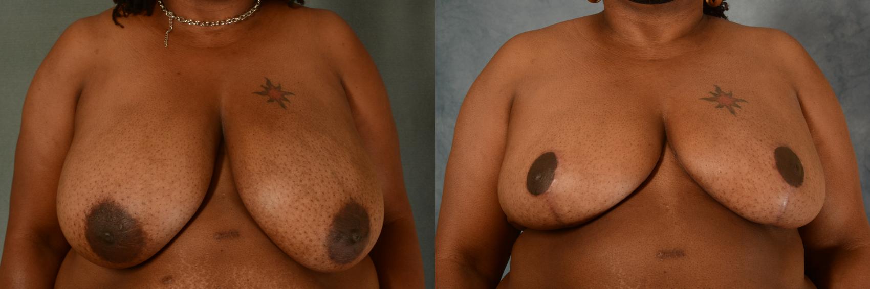 Before & After Breast Reduction Case 474 Front View in Tallahassee, FL