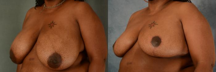 Before & After Breast Reduction Case 474 Left Oblique View in Tallahassee, FL