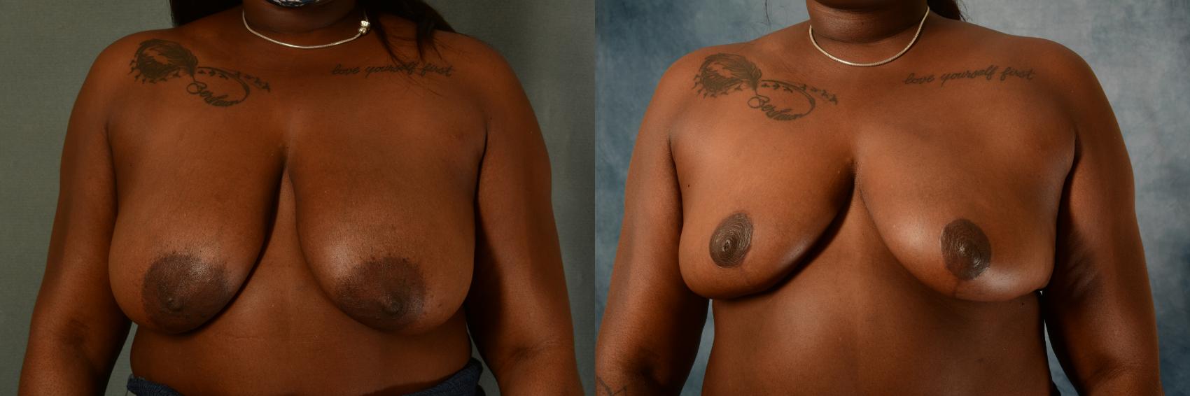 Before & After Breast Reduction Case 481 Front View in Tallahassee, FL