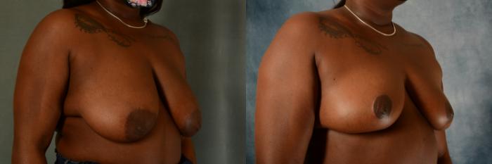 Before & After Breast Reduction Case 481 Right Oblique View in Tallahassee, FL