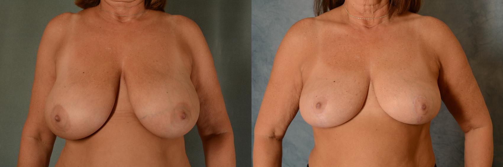 Before & After Breast Reduction Case 484 Front View in Tallahassee, FL