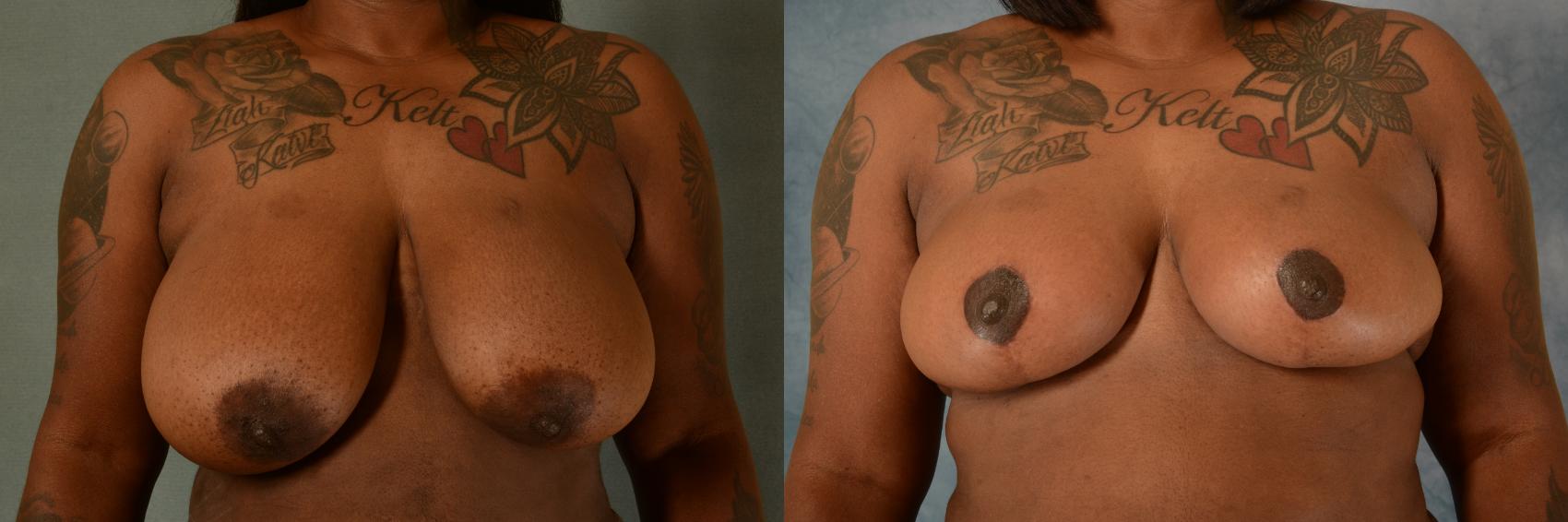 Before & After Breast Reduction Case 486 Front View in Tallahassee, FL