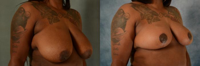 Before & After Breast Reduction Case 486 Left Oblique View in Tallahassee, FL