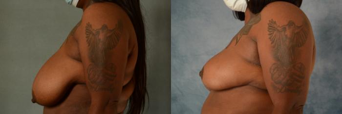 Before & After Breast Reduction Case 486 Left Side View in Tallahassee, FL