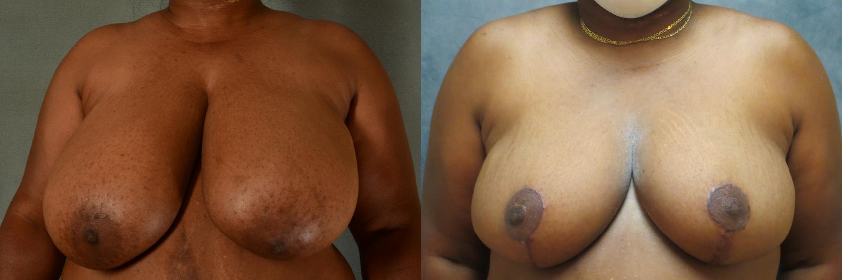 Before & After Breast Reduction Case 490 Front View in Tallahassee, FL