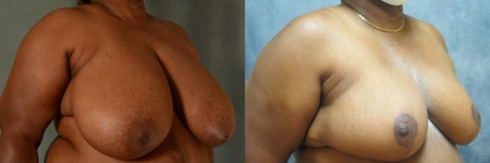 Before & After Breast Reduction Case 490 Right Oblique View in Tallahassee, FL