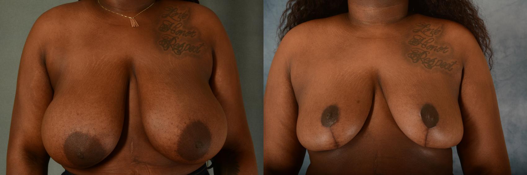 Before & After Breast Reduction Case 509 Front View in Tallahassee, FL