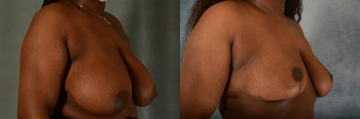 Before & After Breast Reduction Case 509 Right Oblique View in Tallahassee, FL