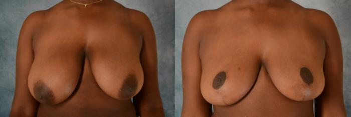 Before & After Breast Reduction Case 531 Front View in Tallahassee, FL