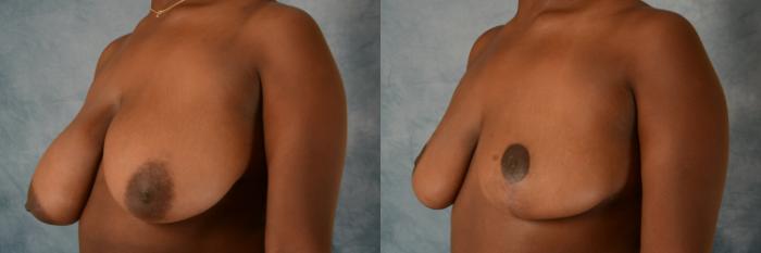 Before & After Breast Reduction Case 531 Left Oblique View in Tallahassee, FL