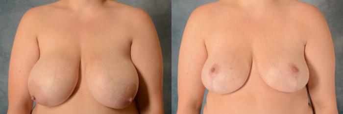 Before & After Breast Reduction Case 546 Front View in Tallahassee, FL