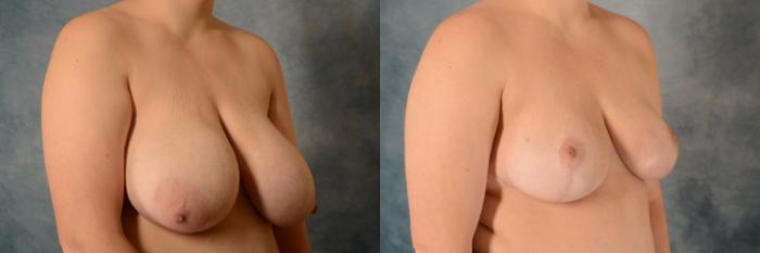 Before & After Breast Reduction Case 546 Right Oblique View in Tallahassee, FL