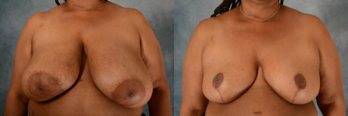 Before & After Breast Reduction Case 551 Front View in Tallahassee, FL