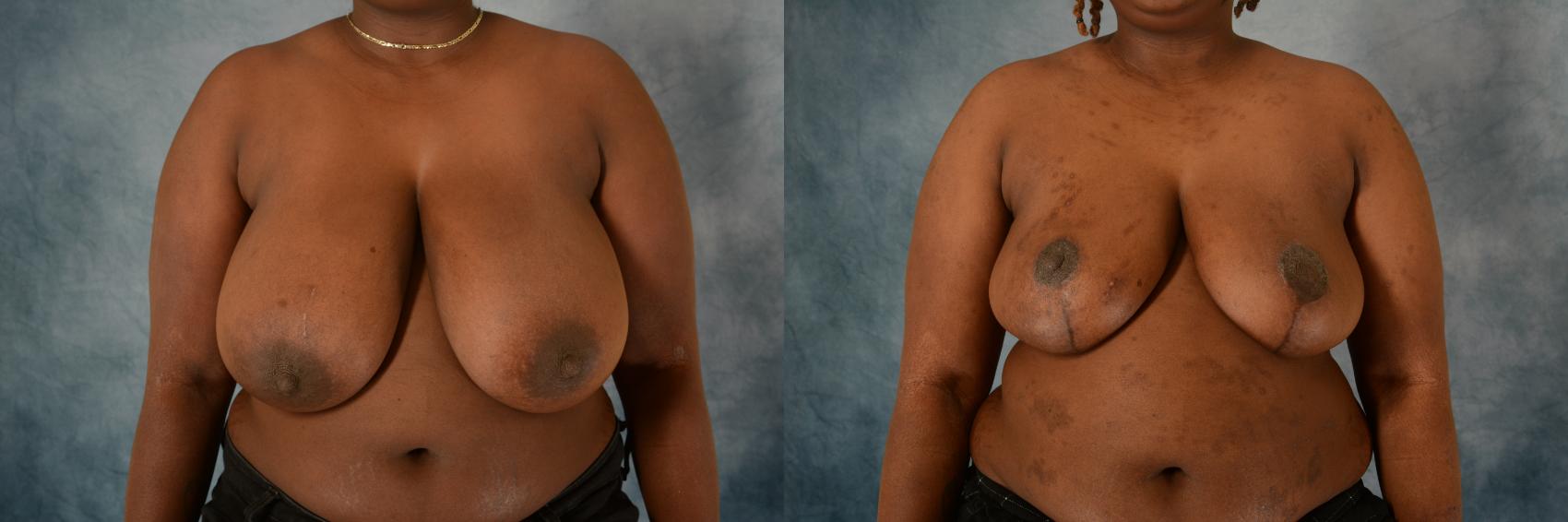 Before & After Breast Reduction Case 562 Front View in Tallahassee, FL