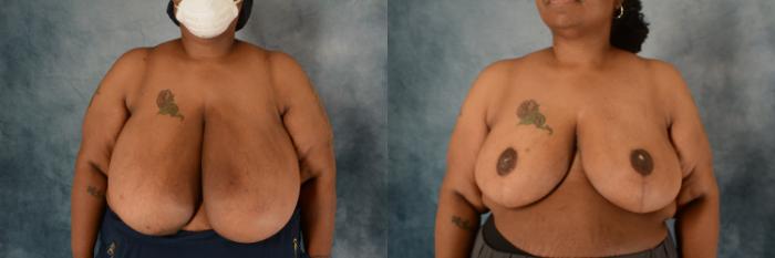 Before & After Breast Reduction Case 566 Front View in Tallahassee, FL