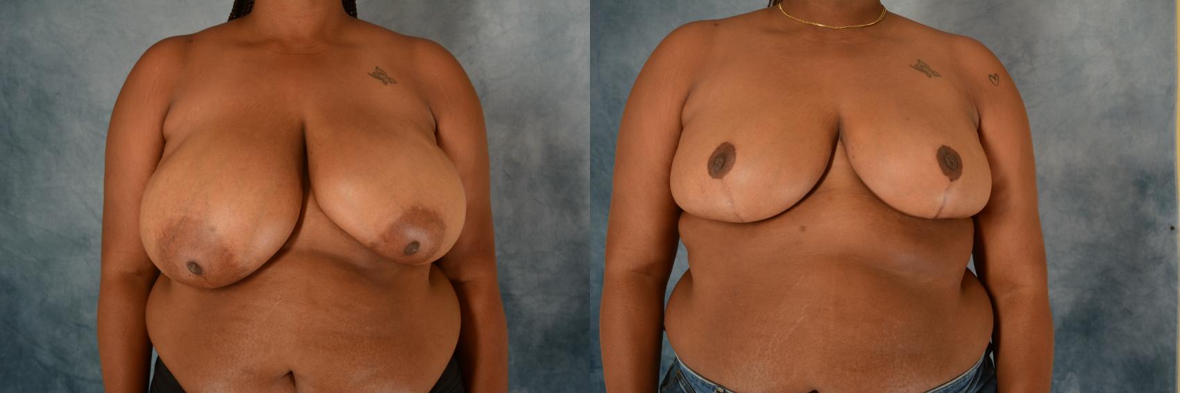 Before & After Breast Reduction Case 571 Front View in Tallahassee, FL