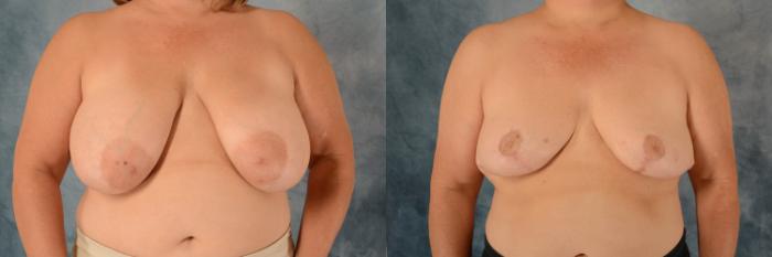 Before & After Breast Reduction Case 574 Front View in Tallahassee, FL