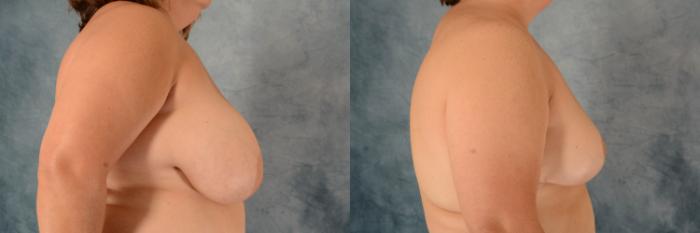 Before & After Breast Reduction Case 574 Right Side View in Tallahassee, FL