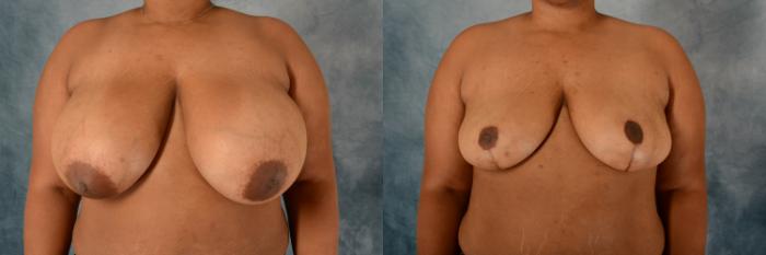 Before & After Breast Reduction Case 592 Front View in Tallahassee, FL