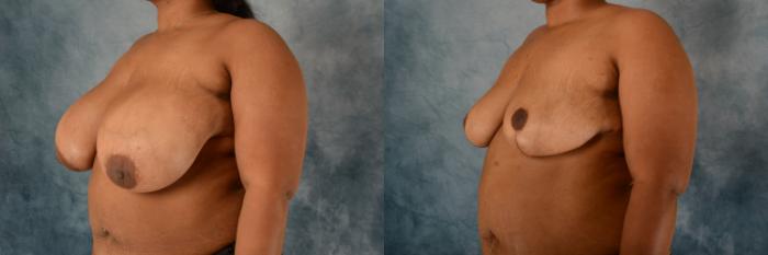 Before & After Breast Reduction Case 592 Left Side View in Tallahassee, FL