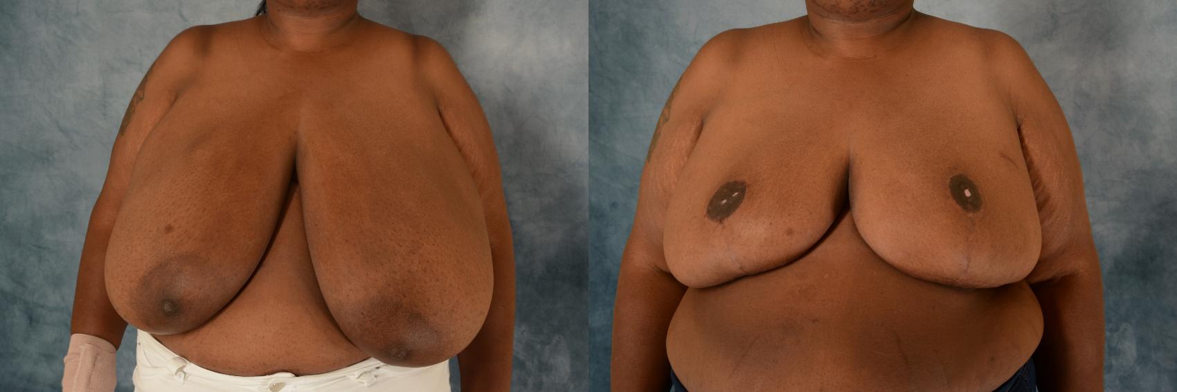 Before & After Breast Reduction Case 599 Front View in Tallahassee, FL