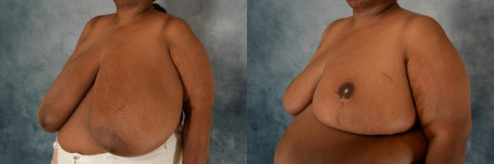 Before & After Breast Reduction Case 599 Left Oblique View in Tallahassee, FL