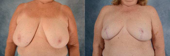 Before & After Breast Reduction Case 607 Front View in Tallahassee, FL