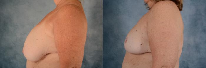 Before & After Breast Reduction Case 607 Left Side View in Tallahassee, FL