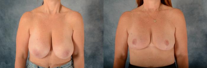 Before & After Breast Reduction Case 612 Front View in Tallahassee, FL