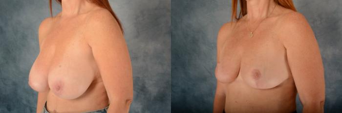 Before & After Breast Reduction Case 612 Left Oblique View in Tallahassee, FL