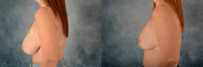Before & After Breast Reduction Case 612 Left Side View in Tallahassee, FL