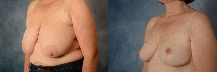 Before & After Breast Reduction Case 617 Left Side View in Tallahassee, FL