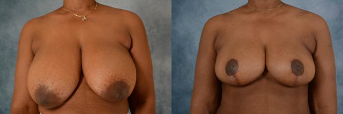 Before & After Breast Reduction Case 619 Front View in Tallahassee, FL