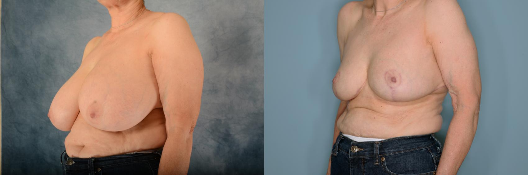 Before & After Breast Reduction Case 643 Front View in Tallahassee, FL