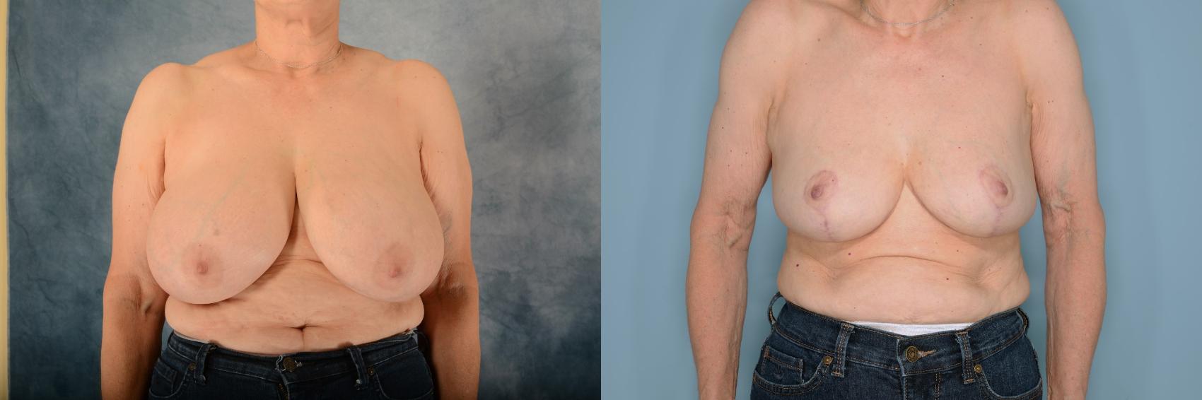 Before & After Breast Reduction Case 644 Front View in Tallahassee, FL