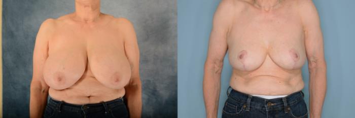 Before & After Breast Reduction Case 644 Front View in Tallahassee, FL