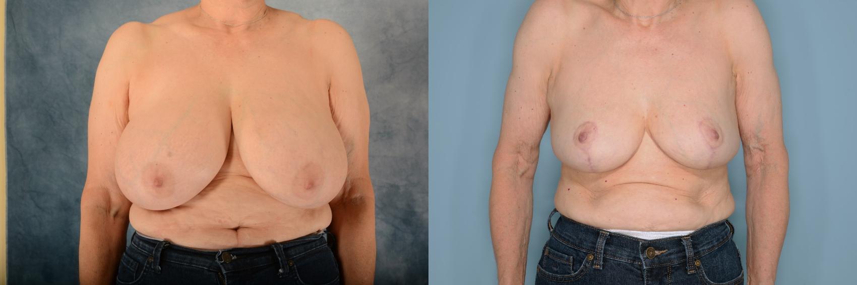 Before & After Breast Reduction Case 645 Front View in Tallahassee, FL
