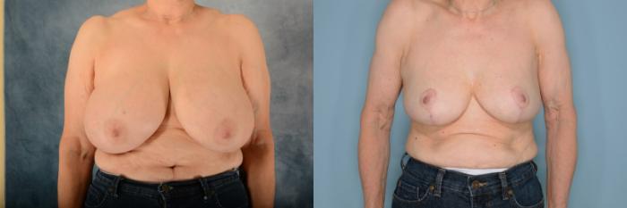 Before & After Breast Reduction Case 645 Front View in Tallahassee, FL
