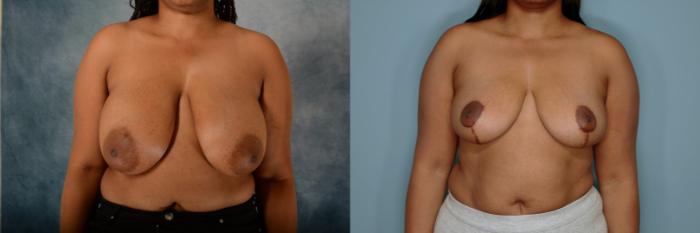 Before & After Breast Reduction Case 646 Front View in Tallahassee, FL