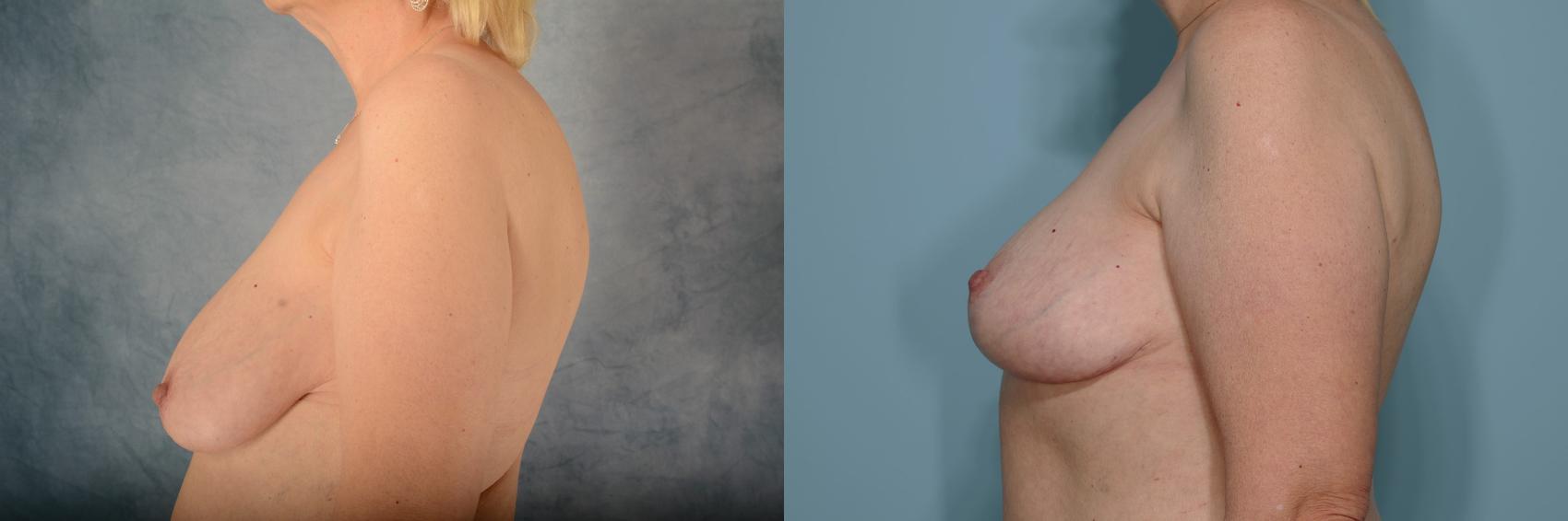 Before & After Breast Reduction Case 647 Left Side View in Tallahassee, FL
