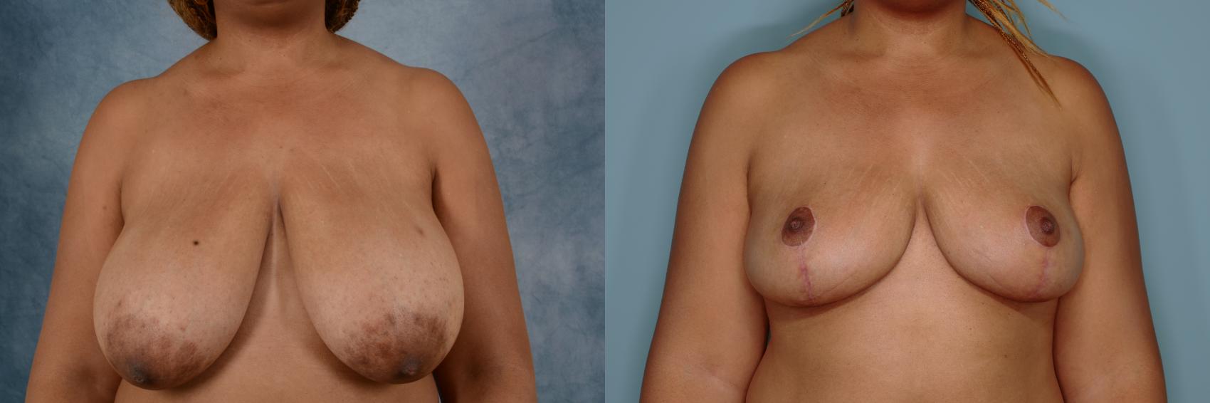 Before & After Breast Reduction Case 676 Front View in Tallahassee, FL