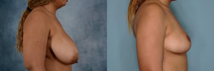 Before & After Breast Reduction Case 676 Right Side View in Tallahassee, FL